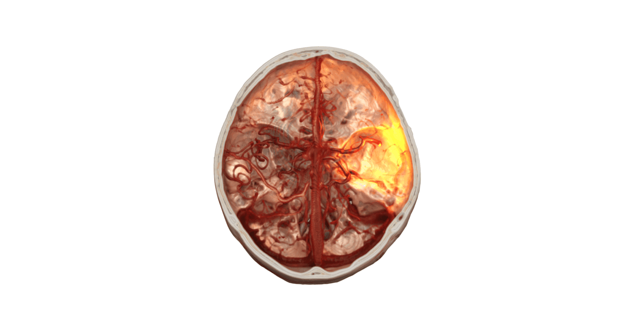 Siemens Healthineers Awarded $31 Million for Stroke Treatment Robotics