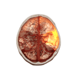 Siemens Healthineers Awarded $31 Million for Stroke Treatment Robotics