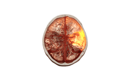 Siemens Healthineers Awarded $31 Million for Stroke Treatment Robotics