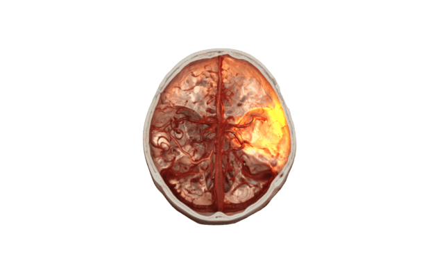 Siemens Healthineers Awarded $31 Million for Stroke Treatment Robotics