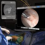 Surgeons Complete First Hip Procedure Using Apple Vision Pro Platform