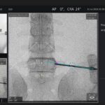 Siemens Healthineers Adds Spine Surgery Guidance Software to Mobile Imaging Systems